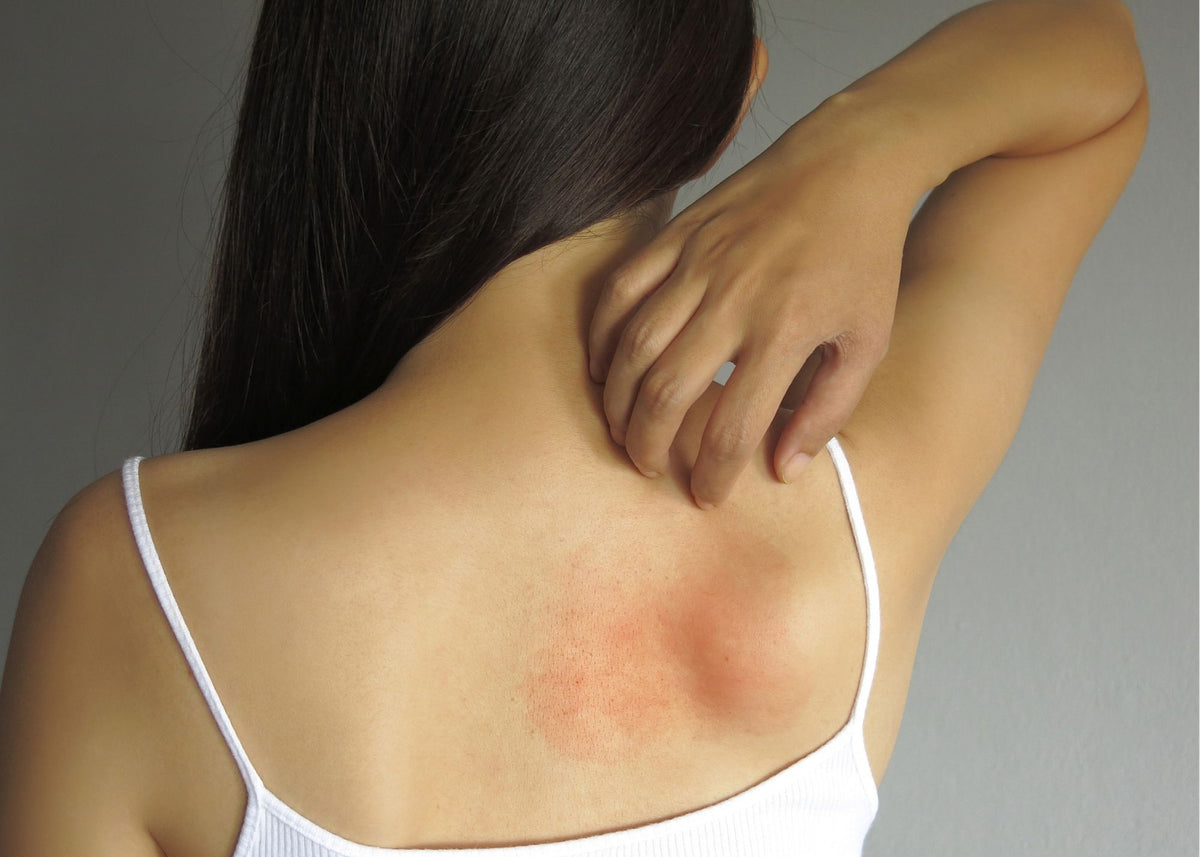 Woman's bare shoulder and back with an irritated red patch of skin