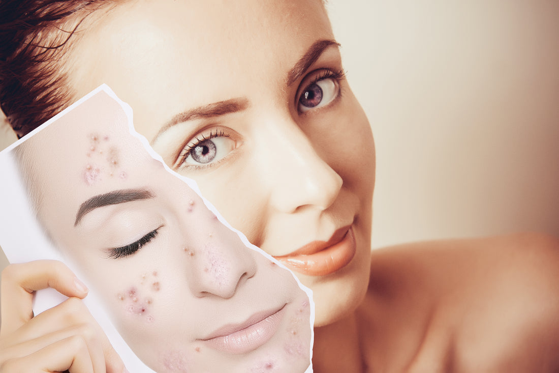 Struggling With Hormonal Acne? Here’s What You Can Do